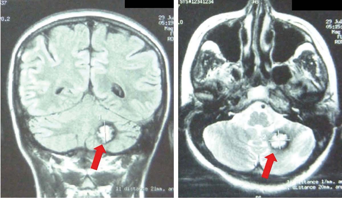 Importanţa RMN în diagnosticul cavernoamelor cerebrale