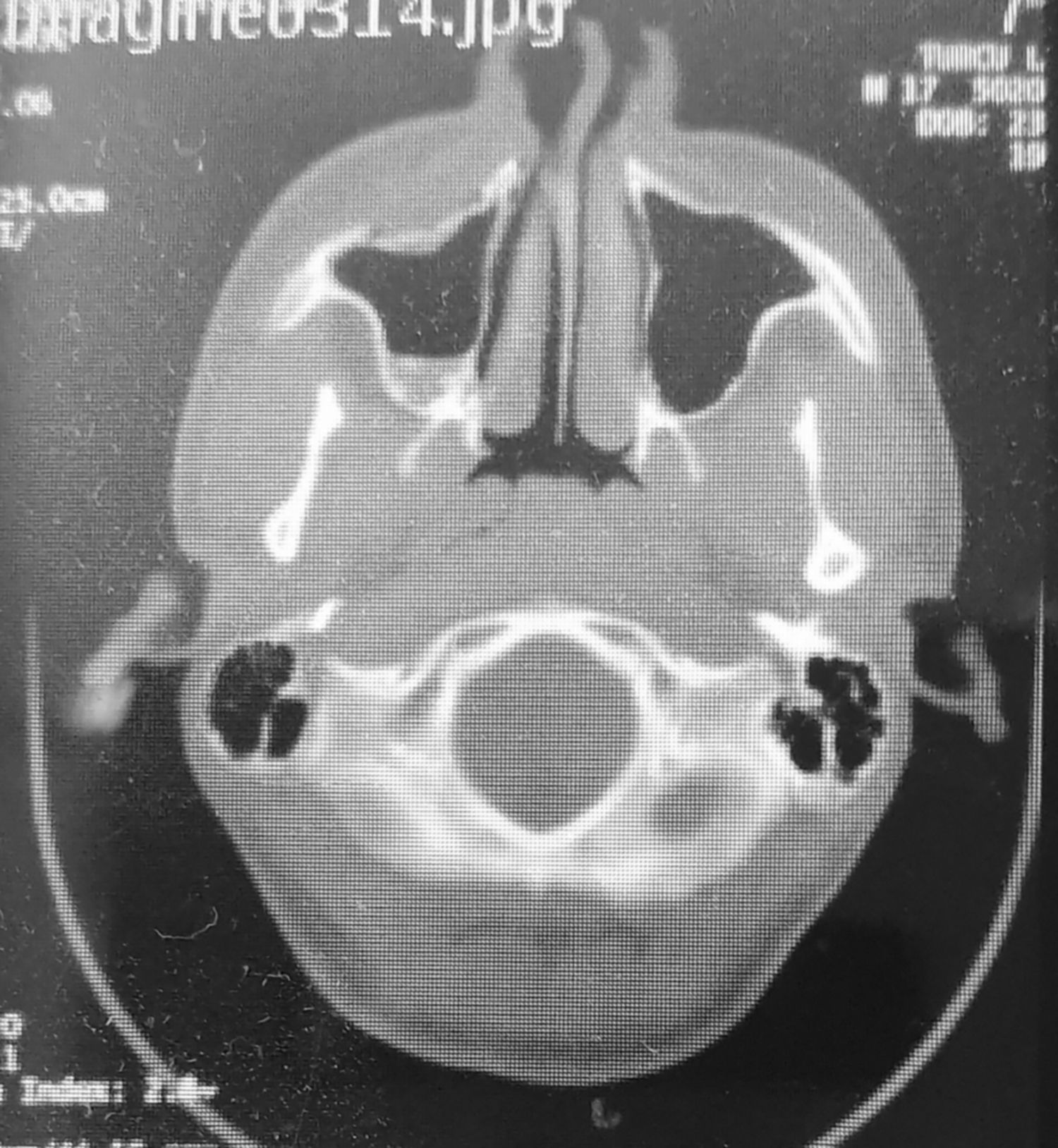 Prezentare de caz: Fractură de sinus maxilar asociat cu hemosinus la copil