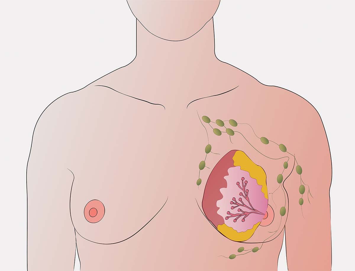 Ganglionul santinelă  în cancerul de sân – concept de actualitate în practica medicală