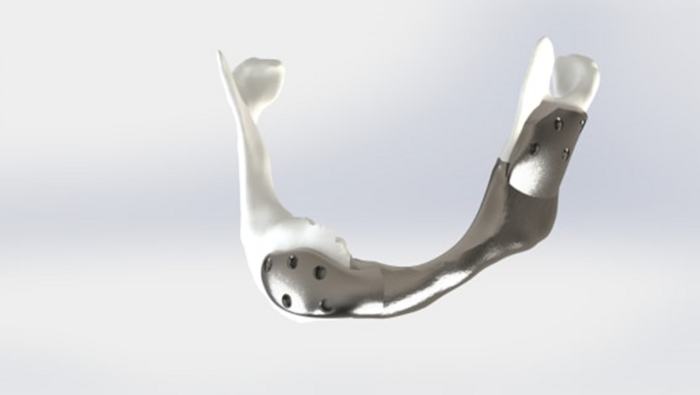 Premieră: mandibulă imprimată 3D la un pacient cu cancer de cap și gât
