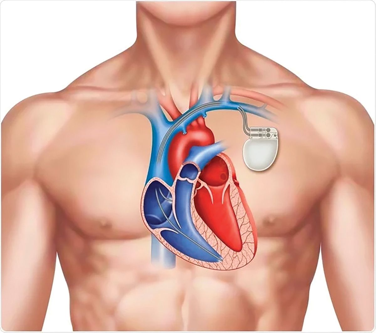 Infecţiile asociate dispozitivelor cardiace implantabile (2)