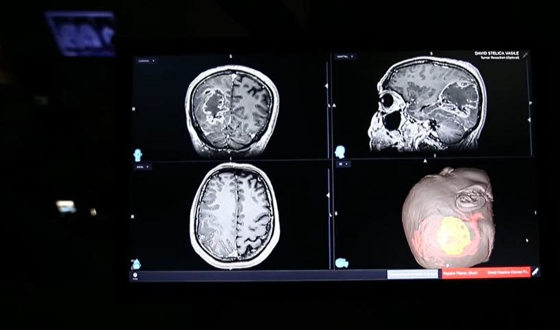 Bărbat de 51 de ani, operat de medicii din Iaşi de o tumoră cerebrală voluminoasă