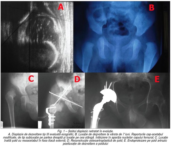 Tratamentul displaziei articulare TB este posibil să opriți artroza articulației șoldului