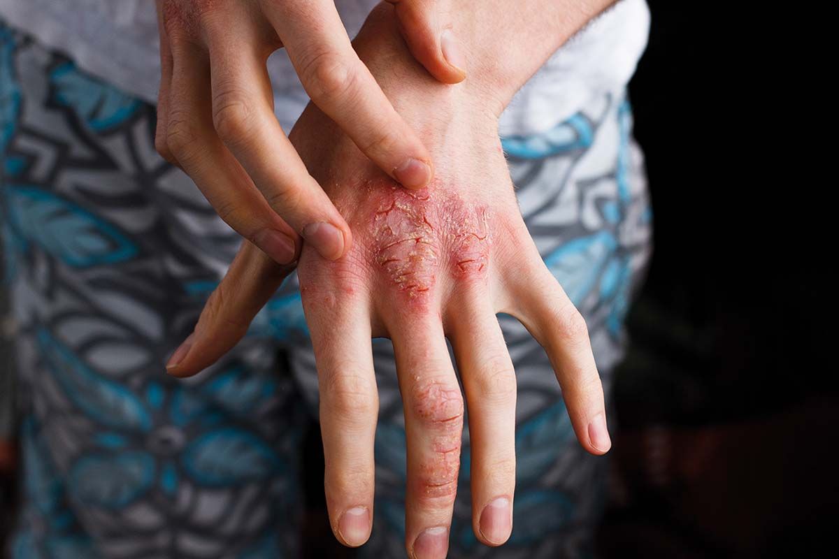 Dermatita atopică, greu de diagnosticat