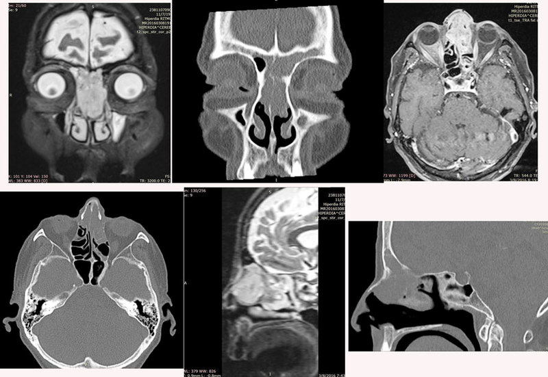 Melanom rino-etmoido-frontal: prezentare de caz