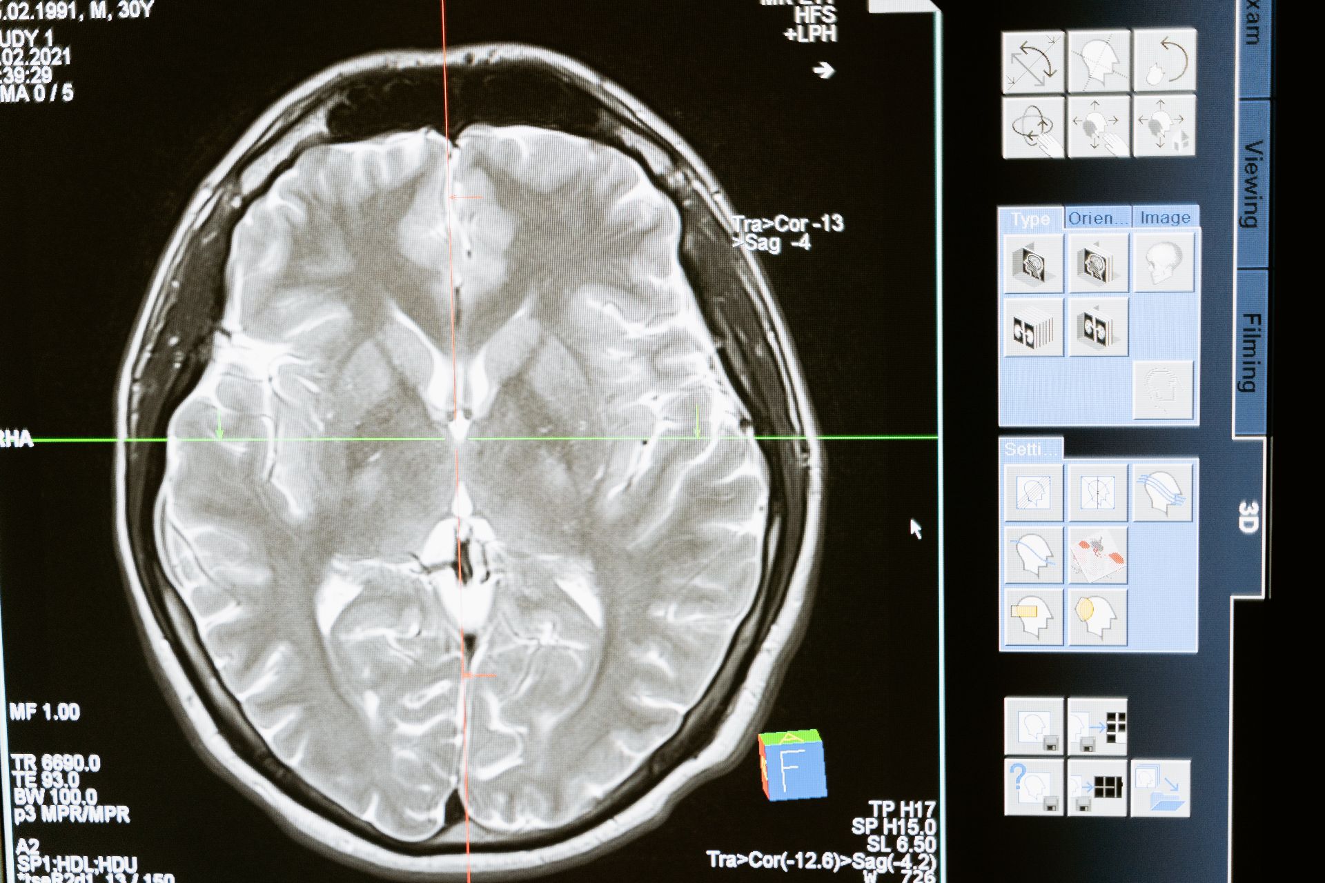 mituri epilepsie creier activitate