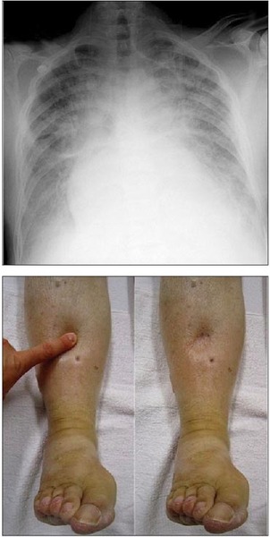Un pas înainte în tratamentul insuficienţei cardiace