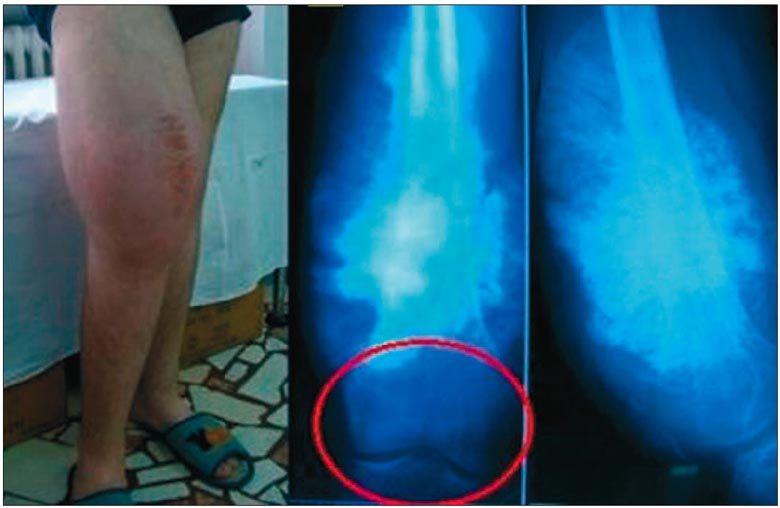 tratament cu sarcom la genunchi