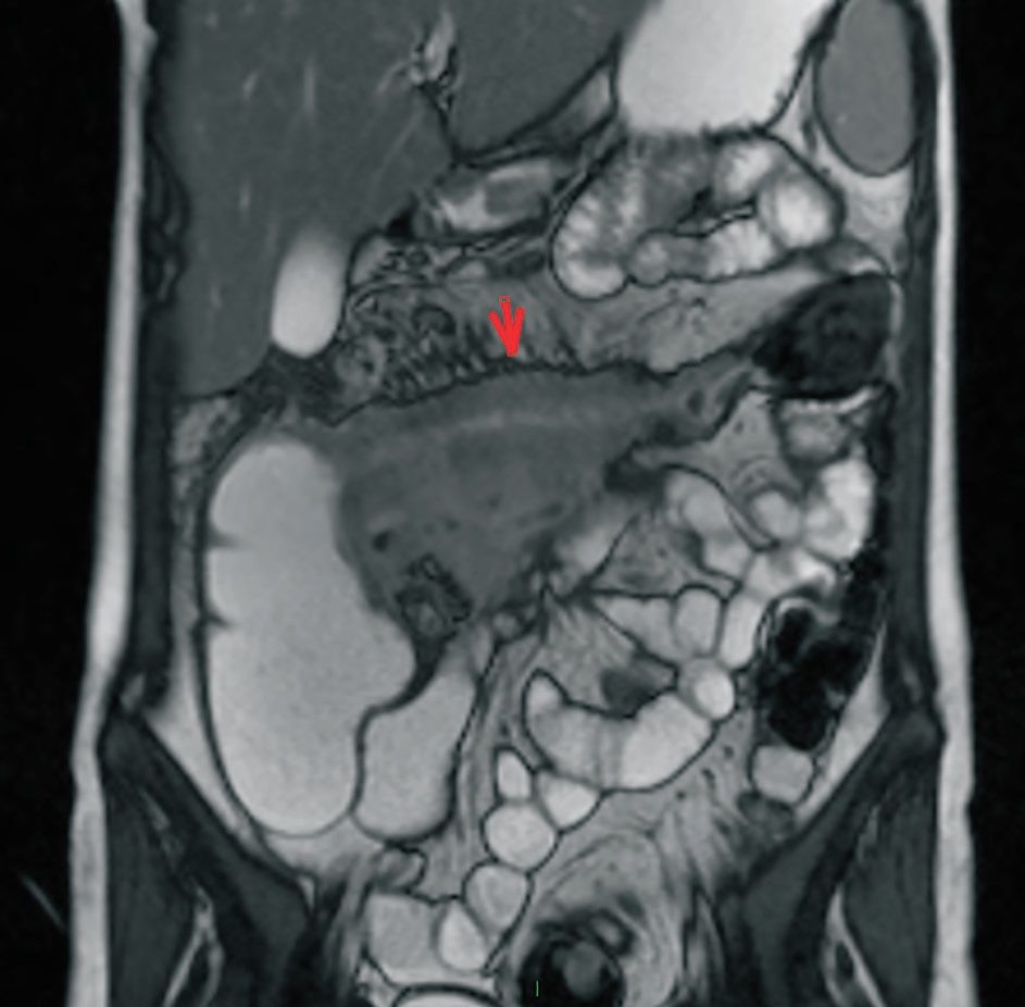 Imagistica în diagnosticul bolii Crohn