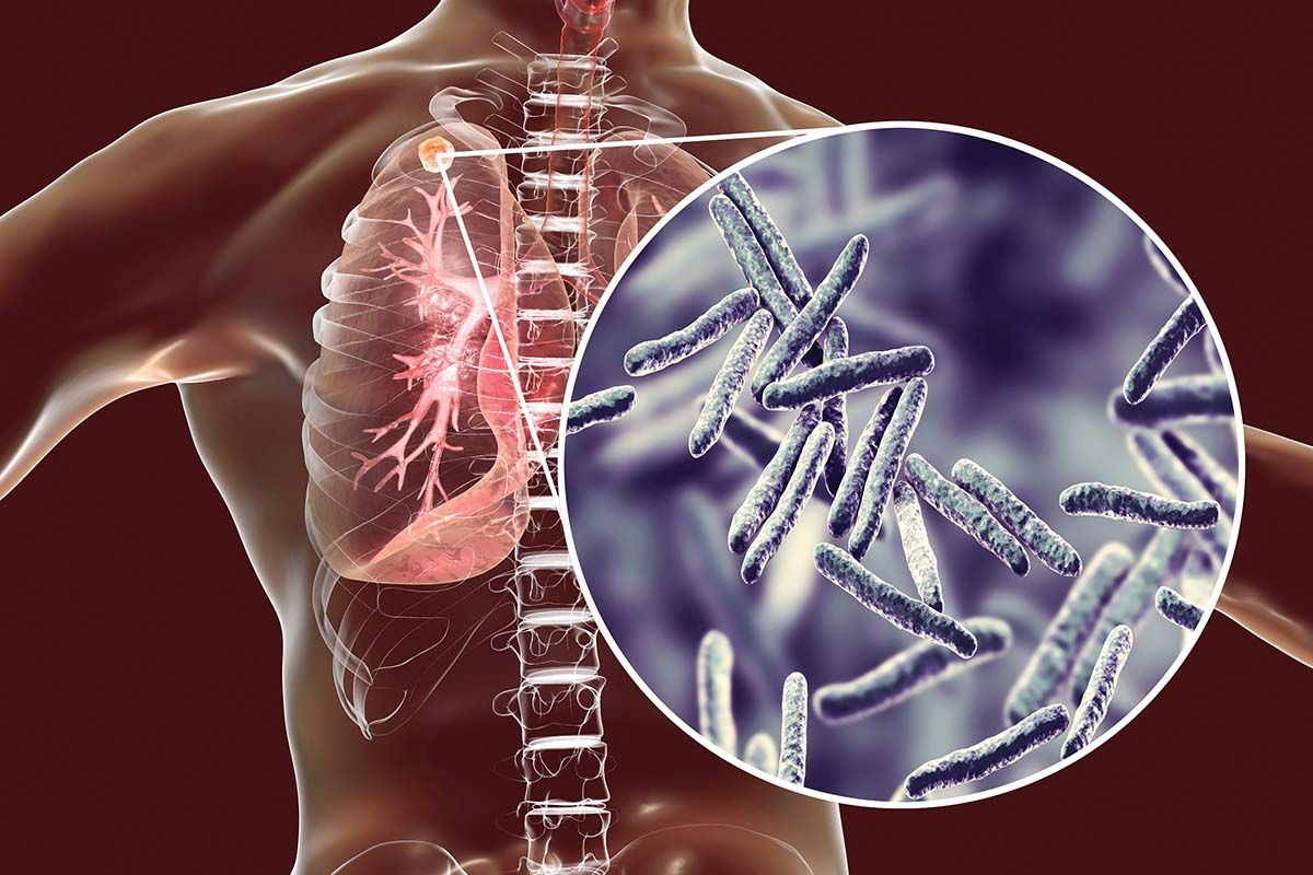 Tratament nou pentru tuberculoza pulmonară