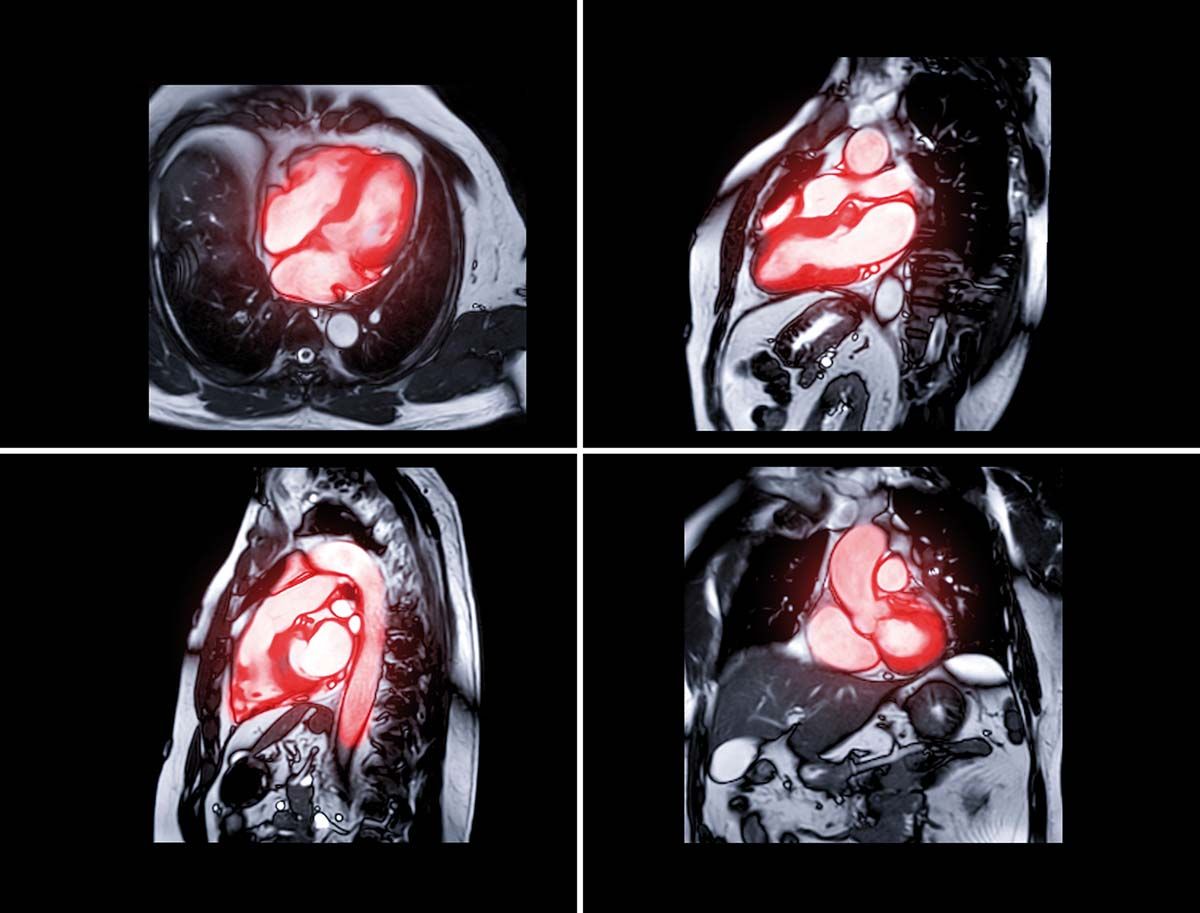 Beneficiile IRM avansată în amiloidoza cardiacă