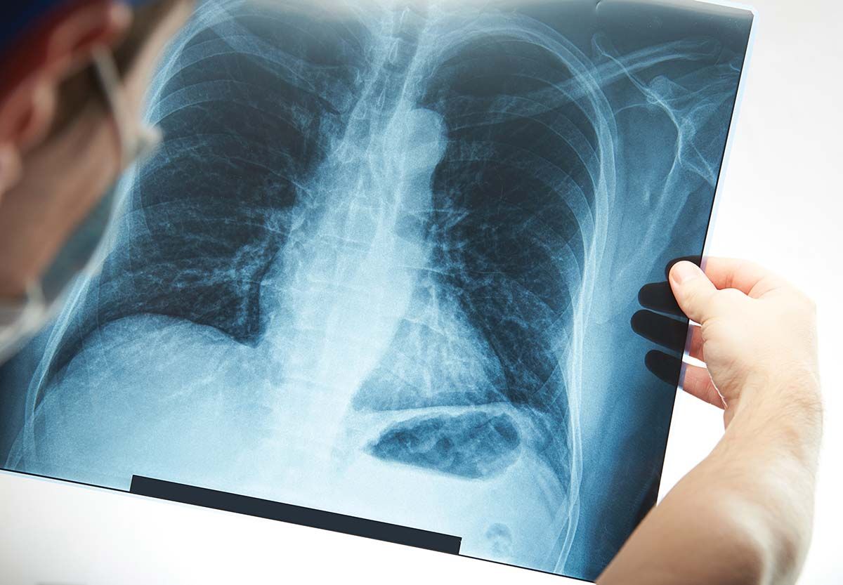 Date incerte despre incidenţa TB în România