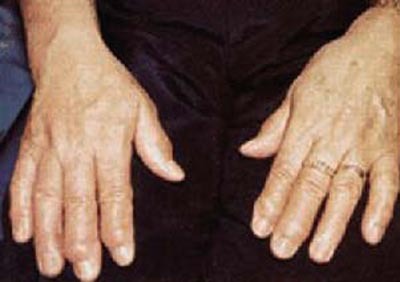 artrita reumatoidă a mâinii)