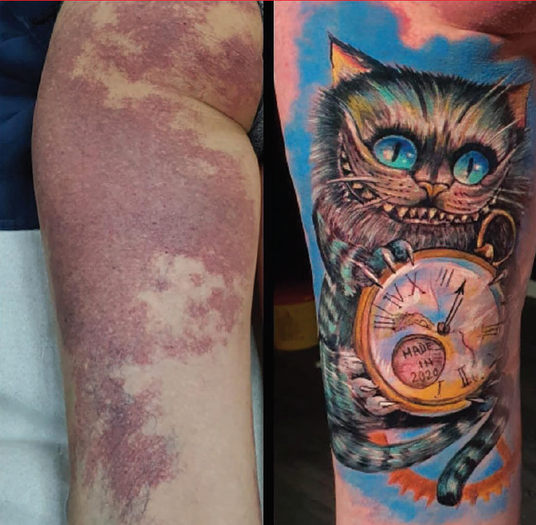 Tatuajele în scop terapeutic, o etapă spre vindecare