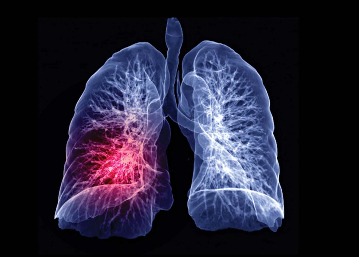 Criterii extinse pentru screeningul cancerului pulmonar