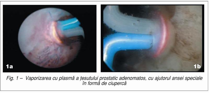 Vaporizarea cu plasmă în tratamentul adenomului de prostată - Viața Medicală