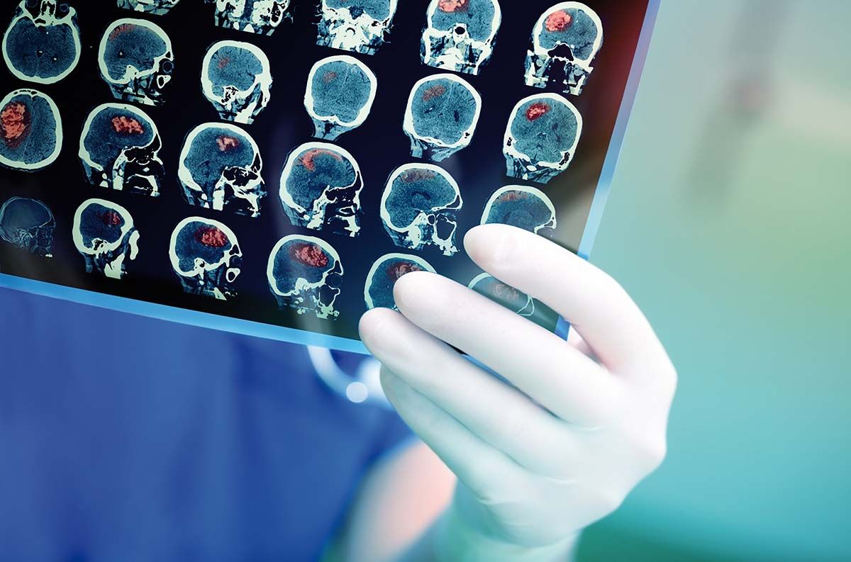 Recomandări privind imagistica cerebrală tip PET-CT