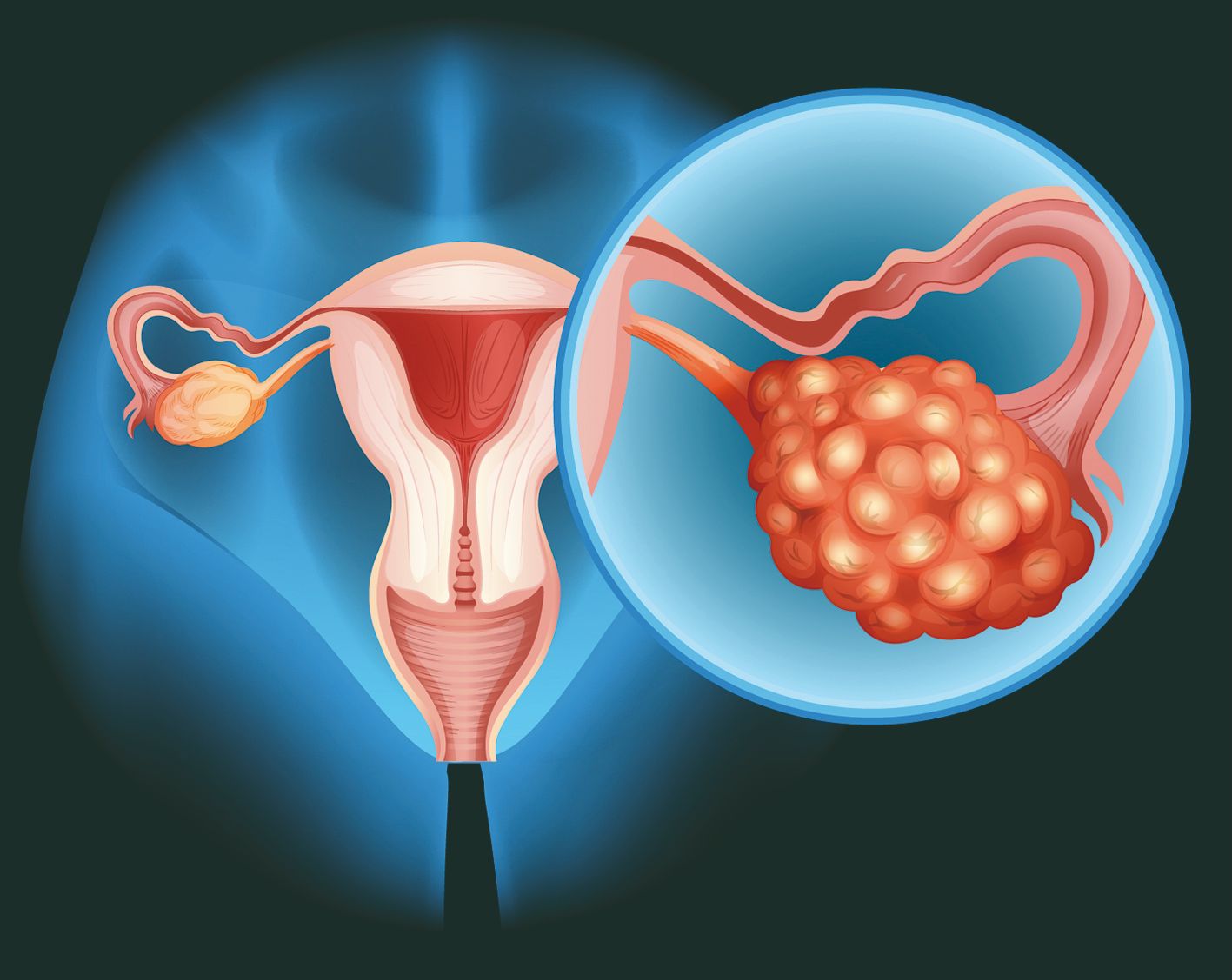 O nouă eră în tratamentul cancerului ovarian