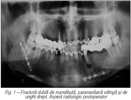 Principiile imobilizării rigide în fracturile de mandibulă