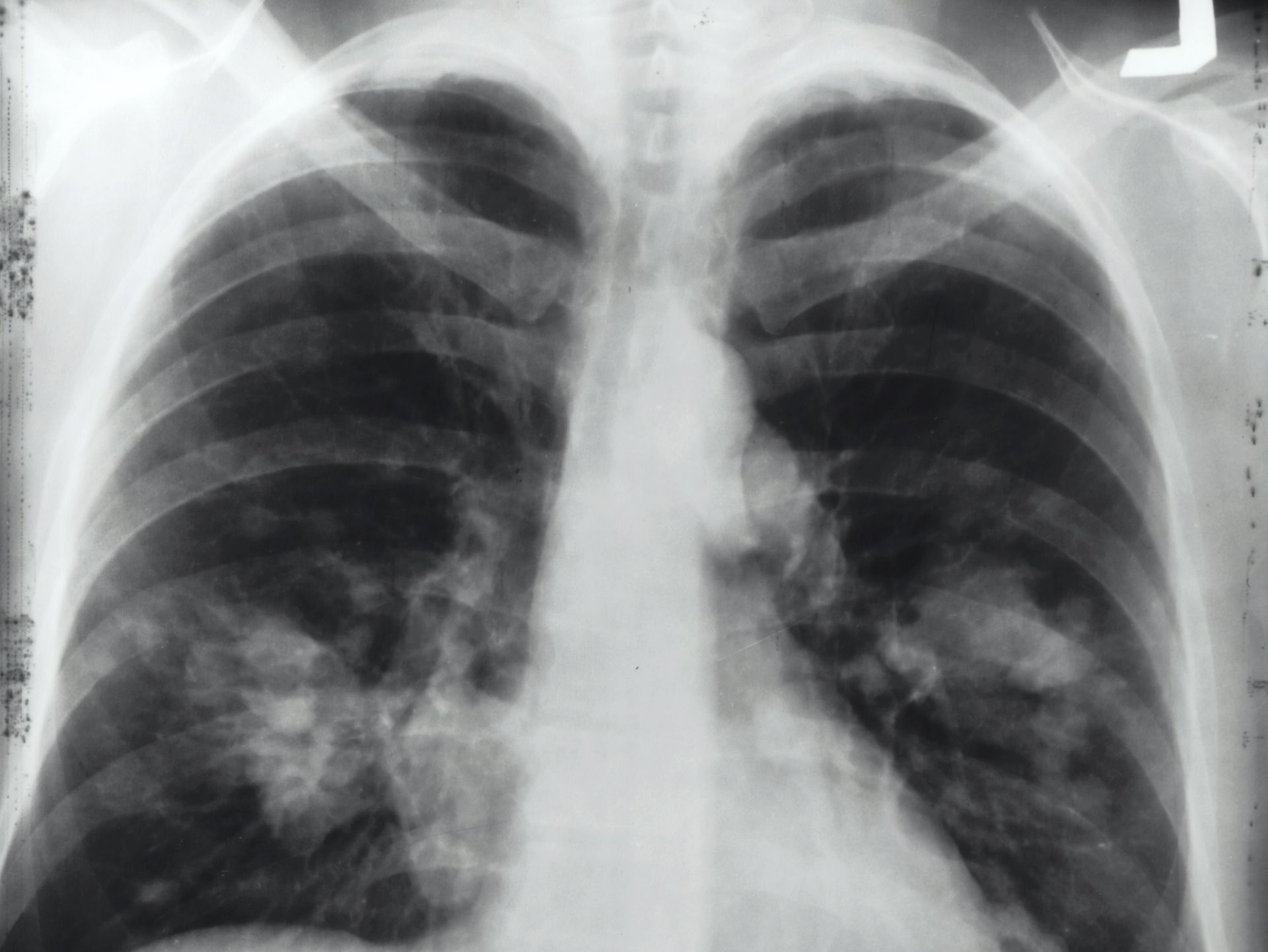 Pacienții post-COVID, risc sporit de a dezvolta probleme respiratorii