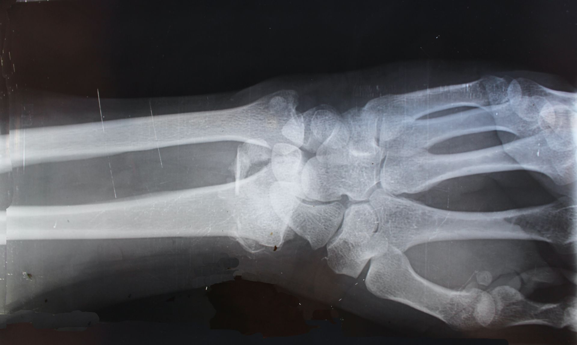 Inteligența artificială în radiologie îmbunătățește identificarea fracturilor