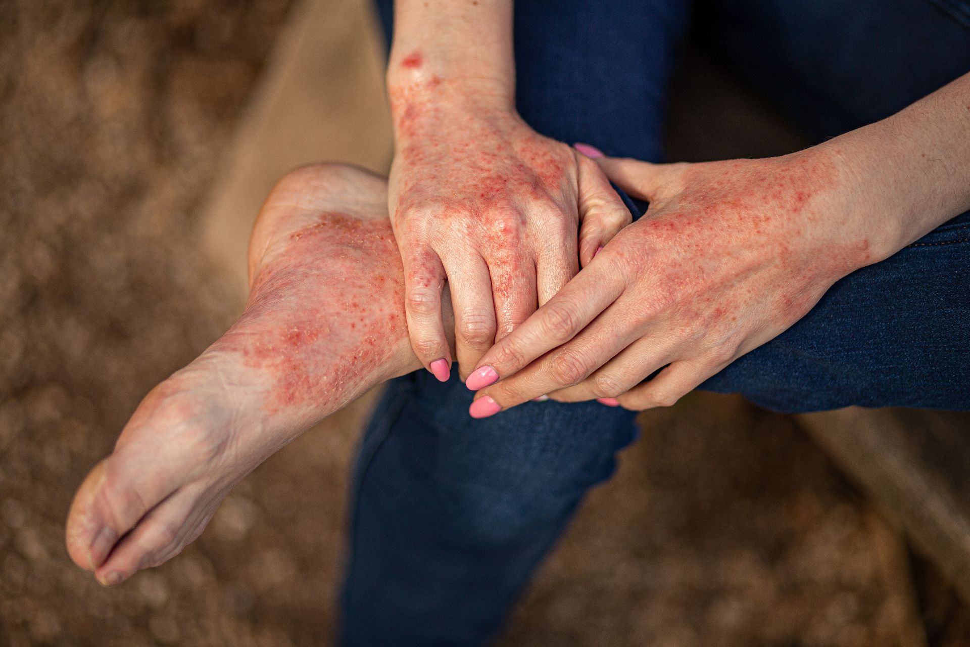 Dermatita atopică  nu mai este un bau-bau