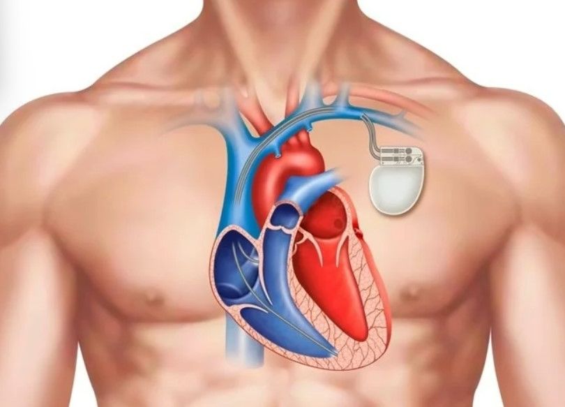 Cum poți face un RMN în siguranță dacă ai un dispozitiv cardiac