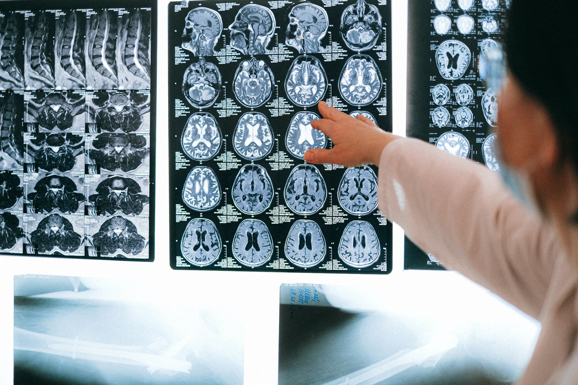 Stimulare cerebrală cu magneți, folosită pentru a trata bolile neurologice