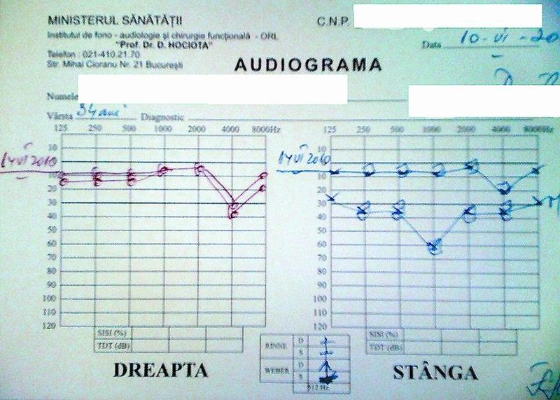 Surditatea brusc instalată – consideraţii asupra unui caz clinic