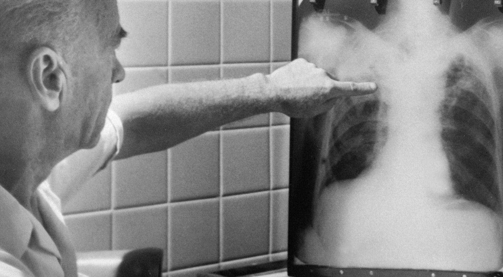 Raport OMS: decesele cauzate de tuberculoză au crescut în perioada pandemiei