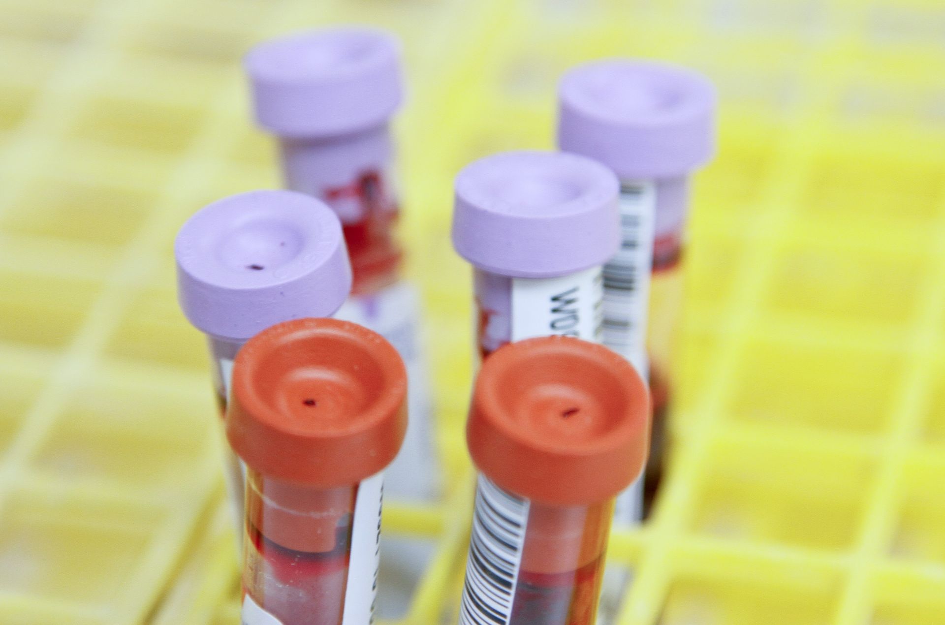 COVID lung: cercetătorii dezvoltă un test sanguin pentru diagnosticare