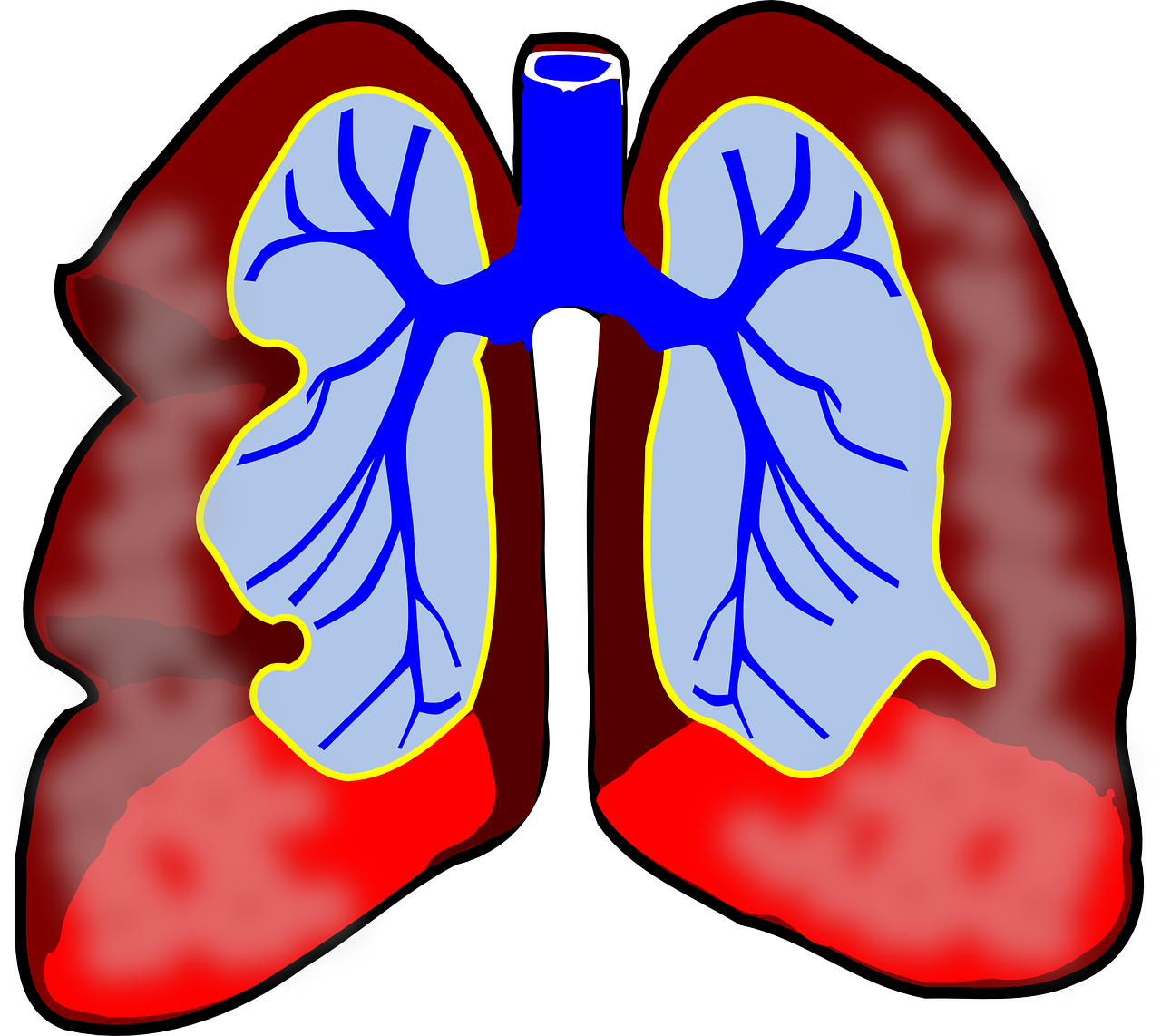 Tratament biologic pentru astmul sever, pe lista medicamentelor compensate