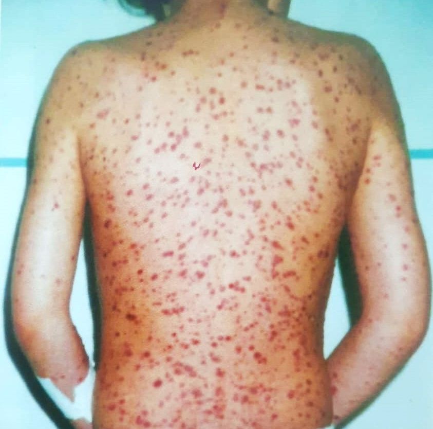 Copil cu o formă rară de varicelă, internat la Spitalul „Victor Babeș” Timișoara