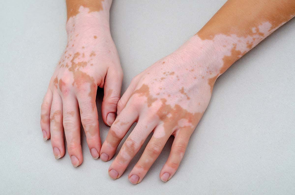 Tratament nou aprobat pentru vitiligo