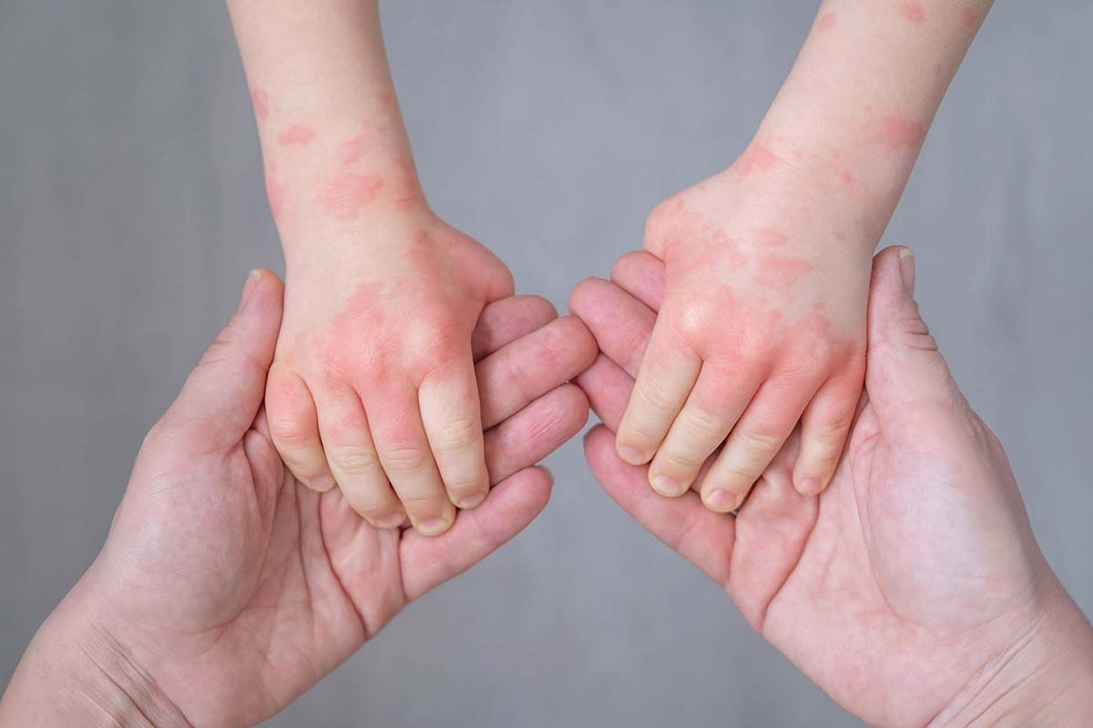 Povara dermatitei atopice, „mai mare decât cea a cancerului”
