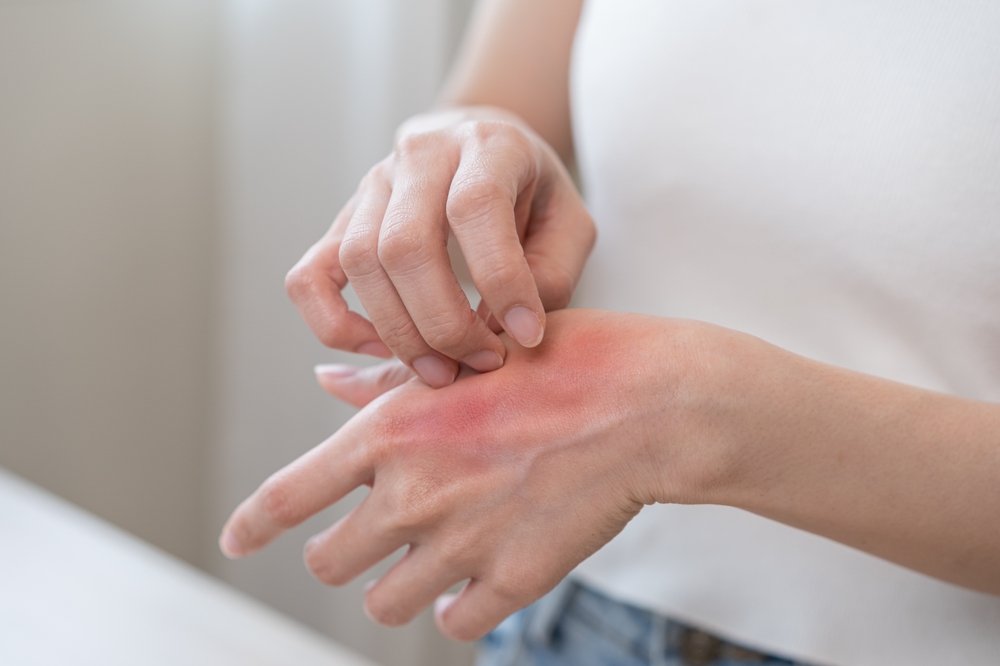 Două din zece persoane cu dermatită atopică au alergii alimentare