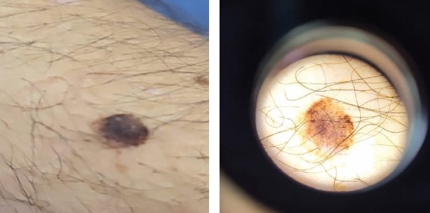 Prezentare de caz: Nevii atipici versus melanomul în fază incipientă