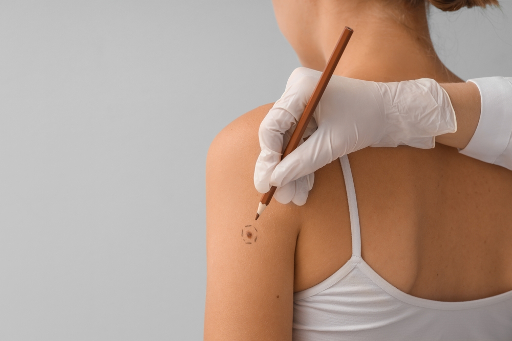 Când o aluniță devine un semnal de alarmă: cum este depistat și tratat melanomul