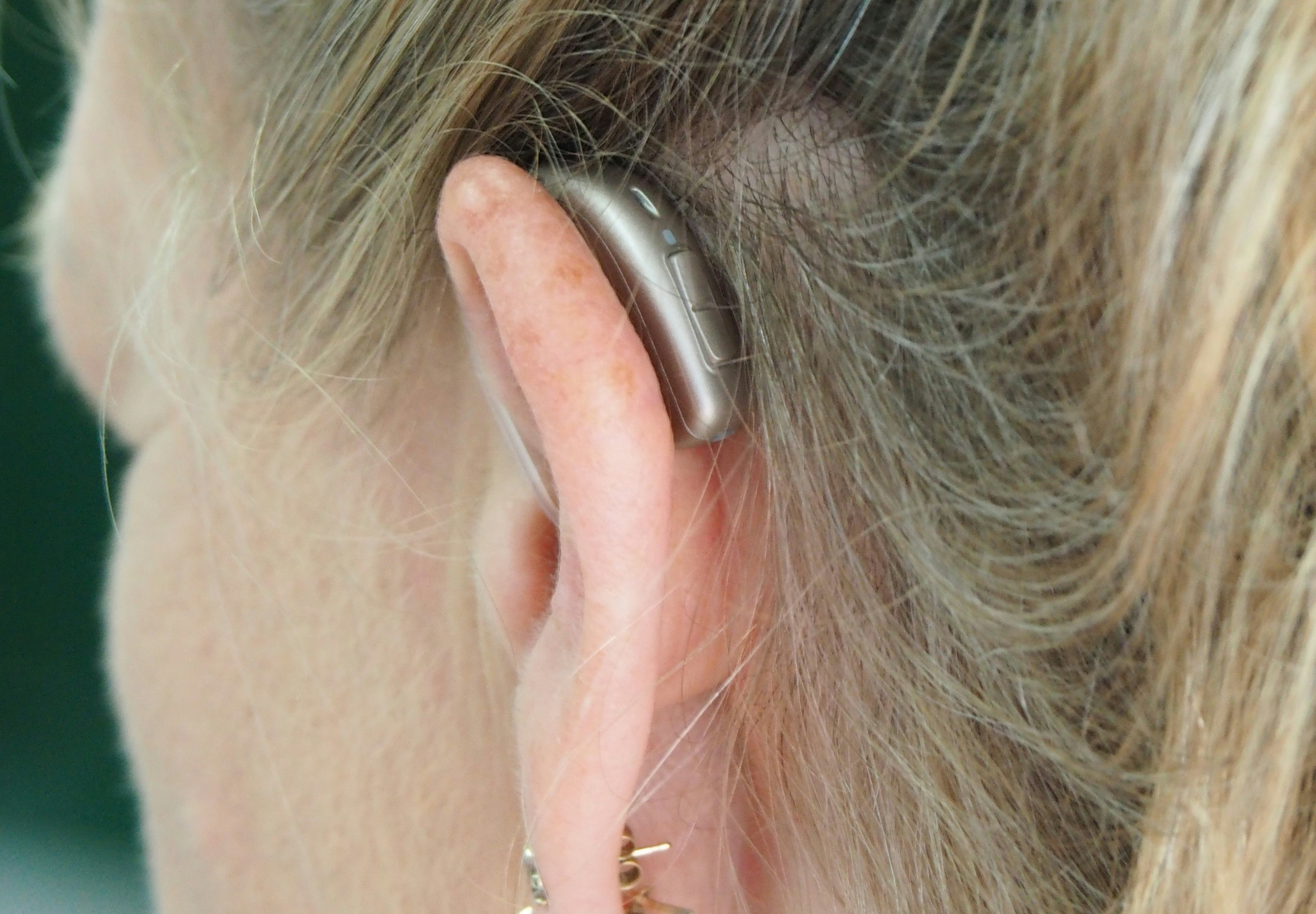 Utilizarea aparatelor auditive poate reduce riscul de demenţă