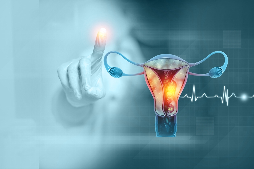 Cancerul endometrial, de la diagnosticare la opțiuni de tratament și șanse de supraviețuire