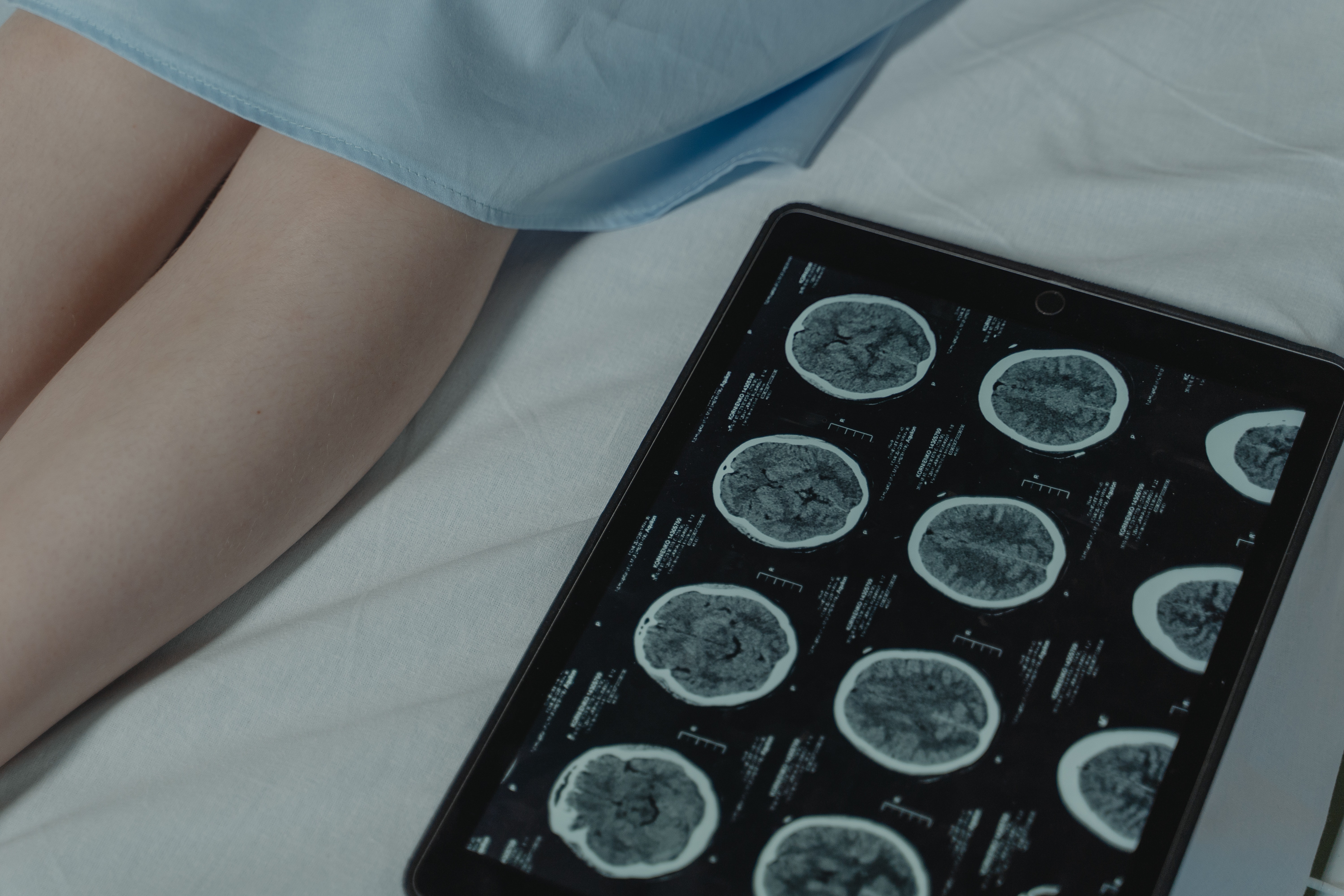 Australia: vierme viu scos din creierul unei paciente cu simptome misterioase