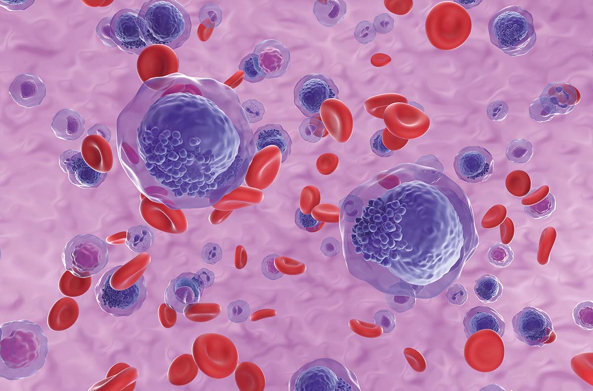 Tratament nou pentru leucemia mieloidă acută