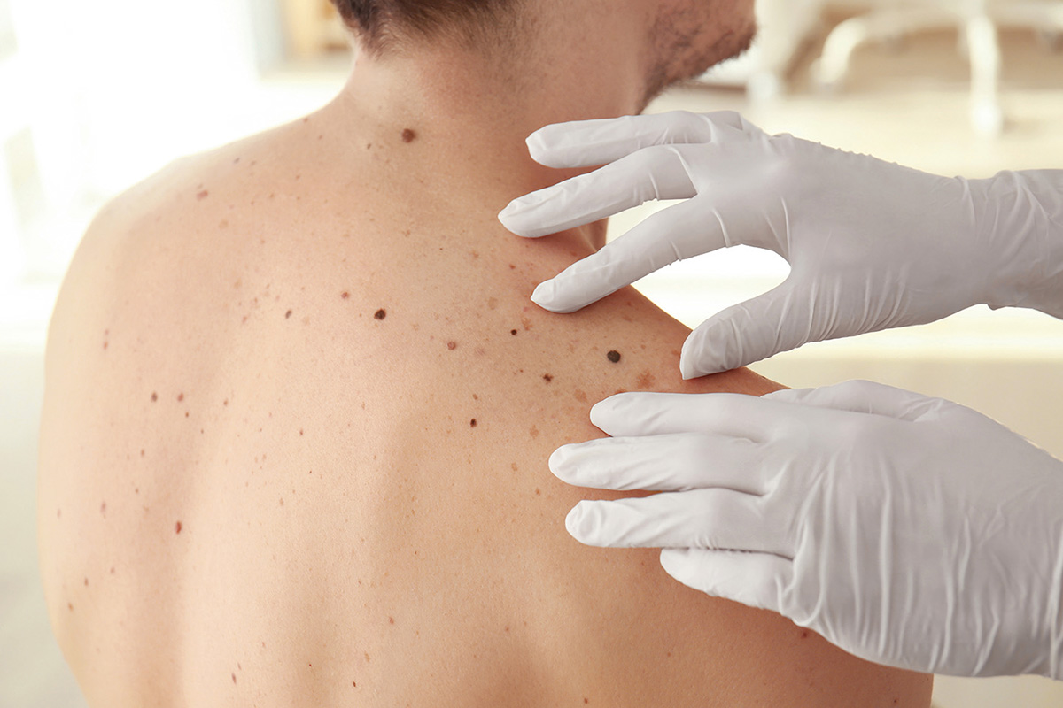 Supravieţuitorii melanomului,  la risc de a dezvolta alte melanoame 