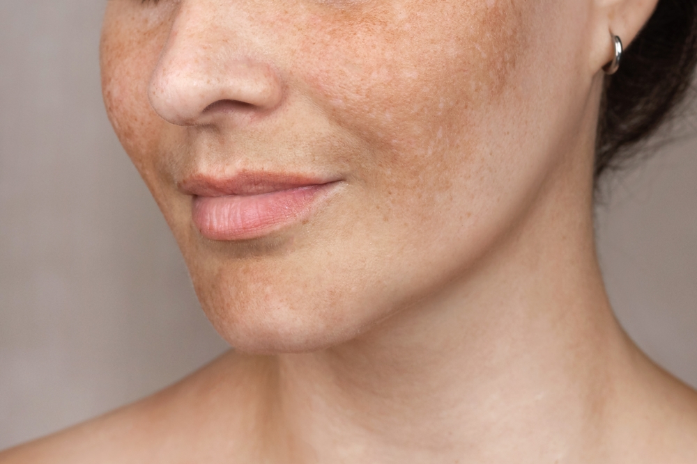 Melasma - diagnostic și tratament: ce recomandă dr. Vali Anton