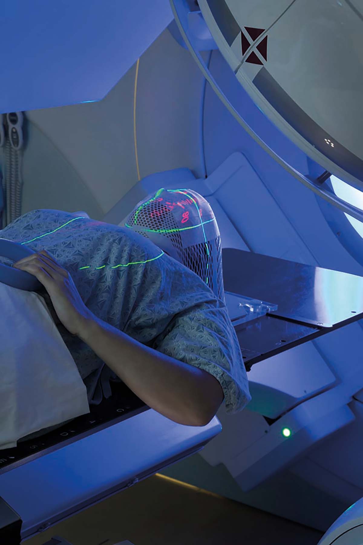 Radioterapia, benefică în gliomul de grad înalt