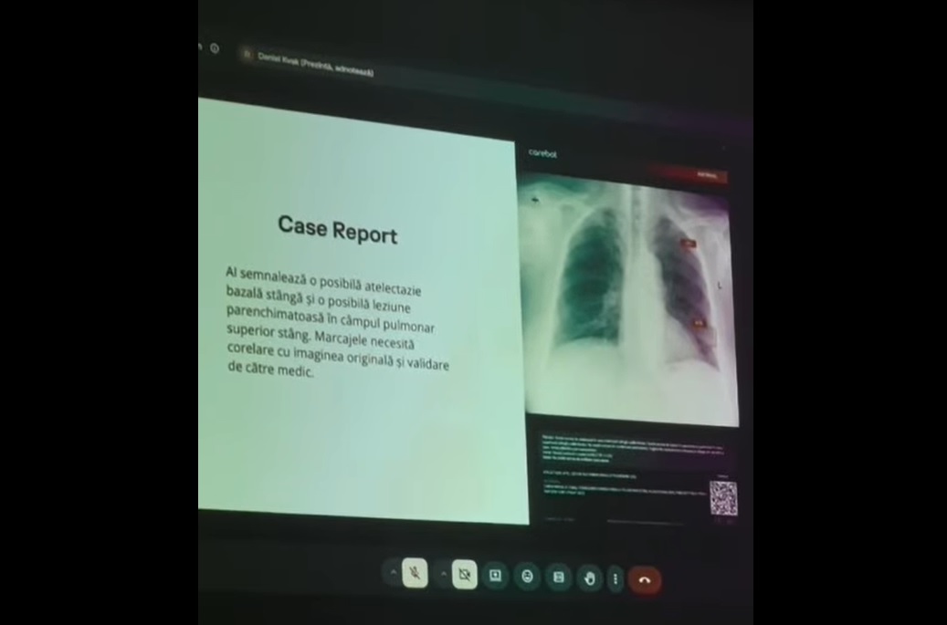 Soluție bazată pe IA, folosită pentru a detecta noduli pulmonari