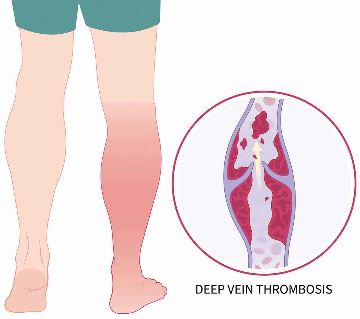 Factori predispozanţi în tromboembolismul venos