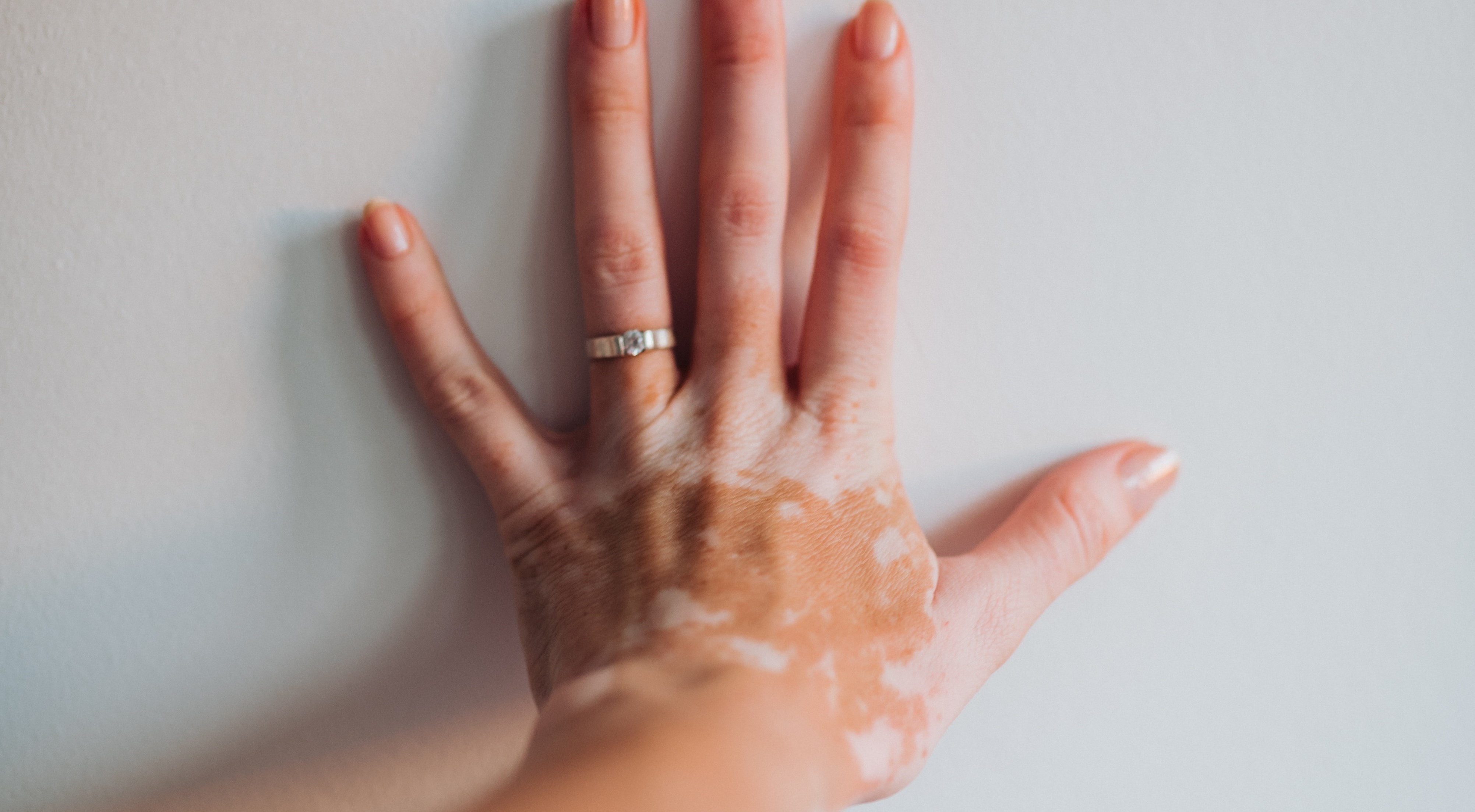 Terapia cu celule stem dă speranțe în tratarea vitiligo